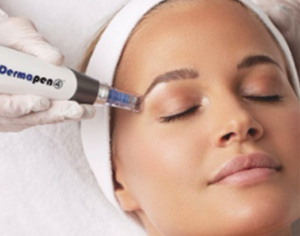 microneedling